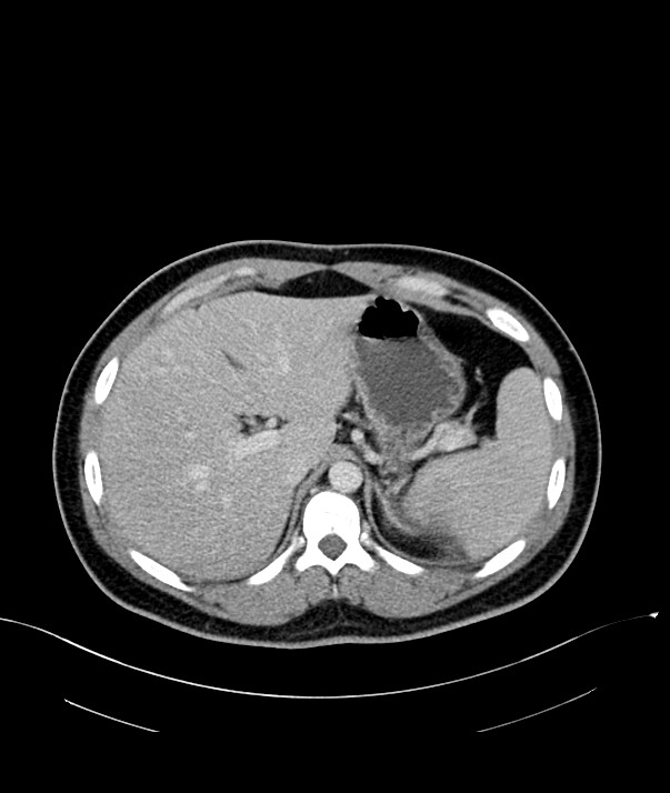 Chromophobe renal cell carcinoma (Radiopaedia 84255-99542 F 19).jpg
