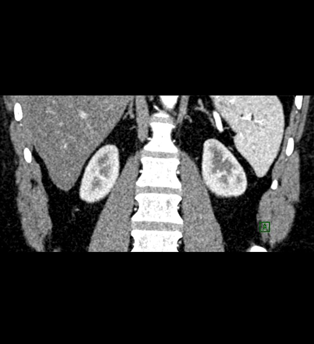 Chromophobe renal cell carcinoma (Radiopaedia 84286-99573 E 64).jpg