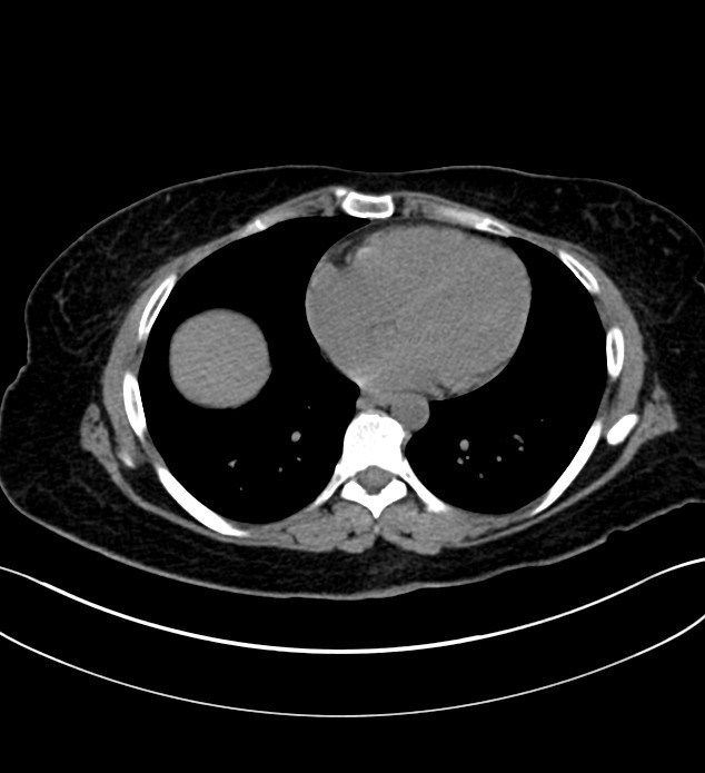 Chromophobe renal cell carcinoma (Radiopaedia 84290-99582 Axial non-contrast 8).jpg