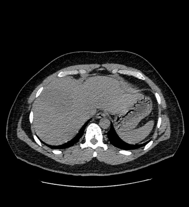 Chromophobe renal cell carcinoma (Radiopaedia 84337-99693 Axial non-contrast 9).jpg