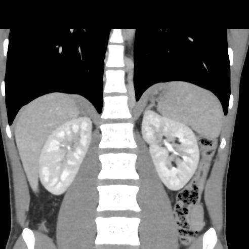 File:Chronic calcific pancreatitis (Radiopaedia 56280-62953 F 21).jpg