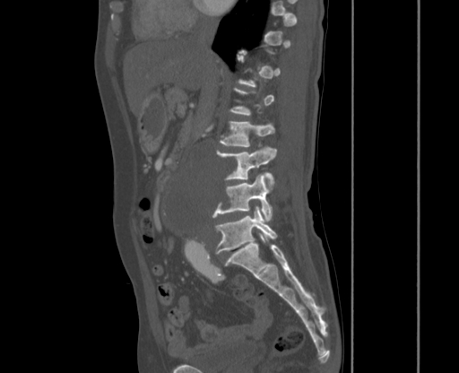 File:Chronic contained rupture of abdominal aortic aneurysm with extensive erosion of the vertebral bodies (Radiopaedia 55450-61901 Sagittal bone window 8).jpg