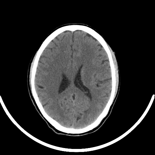 Chronic invasive fungal sinusitis with intraorbital and intracranial extension (Radiopaedia 56387-63046 Axial non-contrast 231).jpg