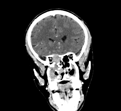Chronic invasive fungal sinusitis with intraorbital and intracranial extension (Radiopaedia 56387-63046 C 134).jpg