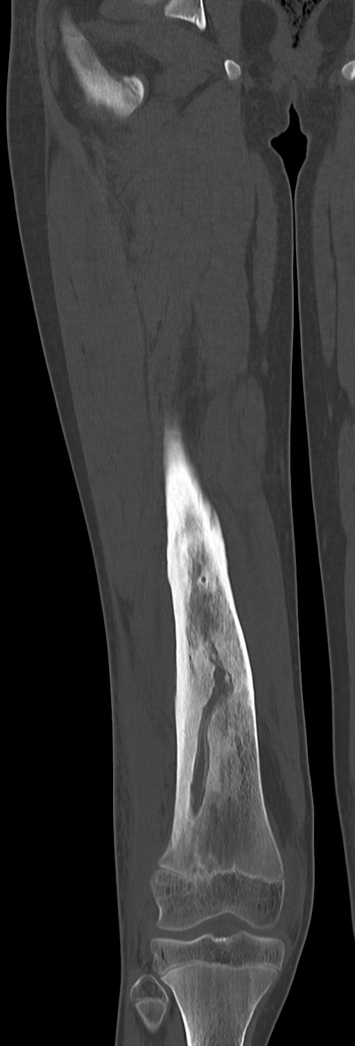 Chronic ostemyelitis of the femur with long sinus tract (Radiopaedia 74947-85982 Coronal bone window 45).jpg