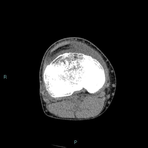 Chronic osteomyelitis (with Brodie abscess) (Radiopaedia 76405-88111 A 103).jpg