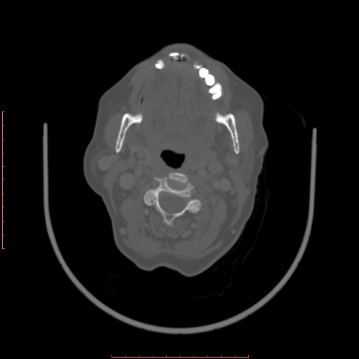 Chronic osteomyelitis - maxilla (Radiopaedia 23783-23927 Axial bone window 46).jpg