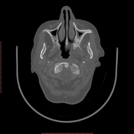 Chronic osteomyelitis - maxilla (Radiopaedia 23783-23927 Axial bone window 95).jpg