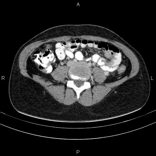 Chronic pancreatitis (Radiopaedia 64576-73450 C 107).jpg