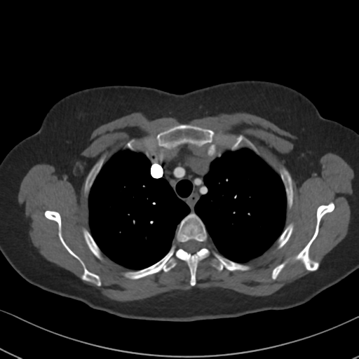 Chronic pulmonary embolus (Radiopaedia 39129-41341 Axial C+ CTPA 24).png