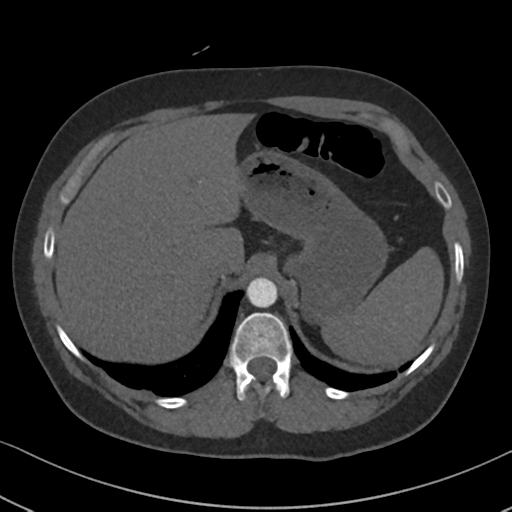 Chronic pulmonary embolus (Radiopaedia 39129-41341 Axial C+ CTPA 94).png