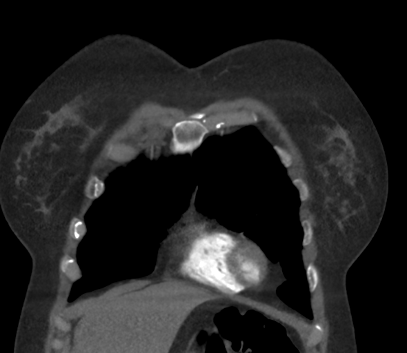 File:Chronic pulmonary embolus (Radiopaedia 39129-41341 Coronal C+ CTPA 18).png