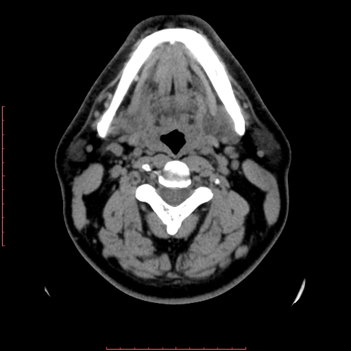 File:Chronic submandibular sialolithiasis (Radiopaedia 69817-79814 Axial non-contrast 110).jpg