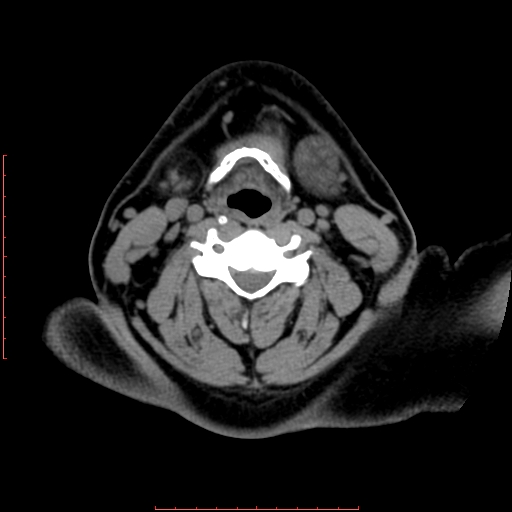 File:Chronic submandibular sialolithiasis (Radiopaedia 69817-79814 Axial non-contrast 146).jpg