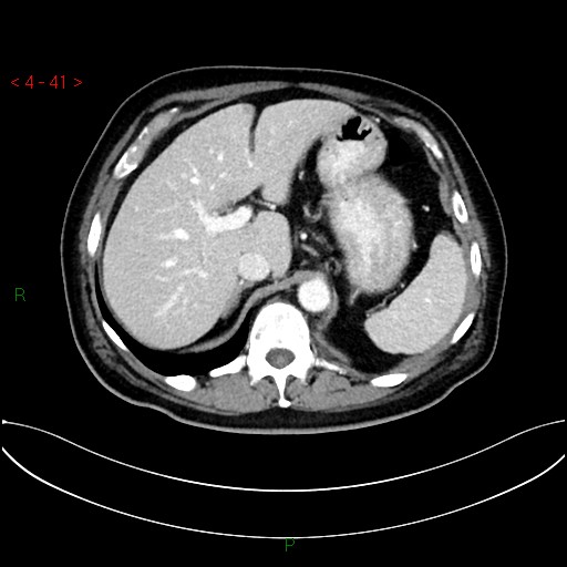 File:Circumaortic left renal vein and doubled left renal arteries (Radiopaedia 52268-58158 B 1).jpg