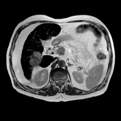 File:Cirrhosis and hepatocellular carcinoma in the setting of hemochromatosis (Radiopaedia 75394-86594 Axial T2 14).jpg