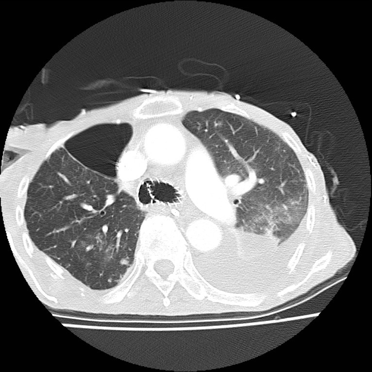 Clagett thoracotomy with bronchopleural fistula (Radiopaedia 29192-29587 Axial lung window 19).jpg