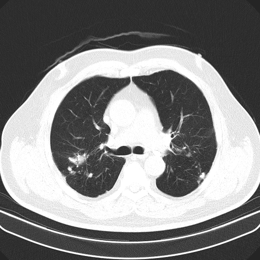 Classic complicated silicosis (Radiopaedia 49720-54961 Axial lung window 22).jpg