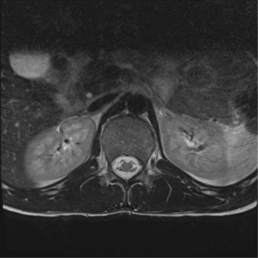 File:Clear cell meningoma - lumbar spine (Radiopaedia 60116-67690 Axial T2 43).png