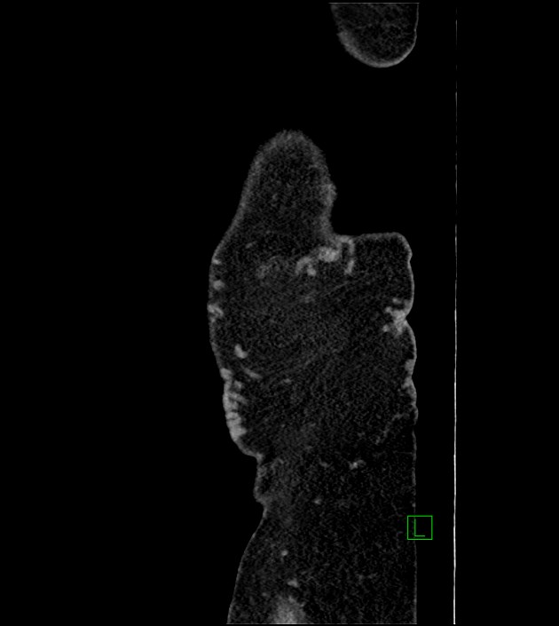 Closed-loop small bowel obstruction-internal hernia (Radiopaedia 78439-91096 C 140).jpg