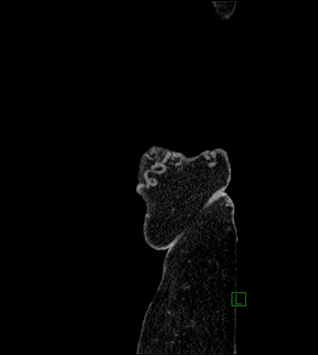 Closed-loop small bowel obstruction-internal hernia (Radiopaedia 78439-91096 C 144).jpg