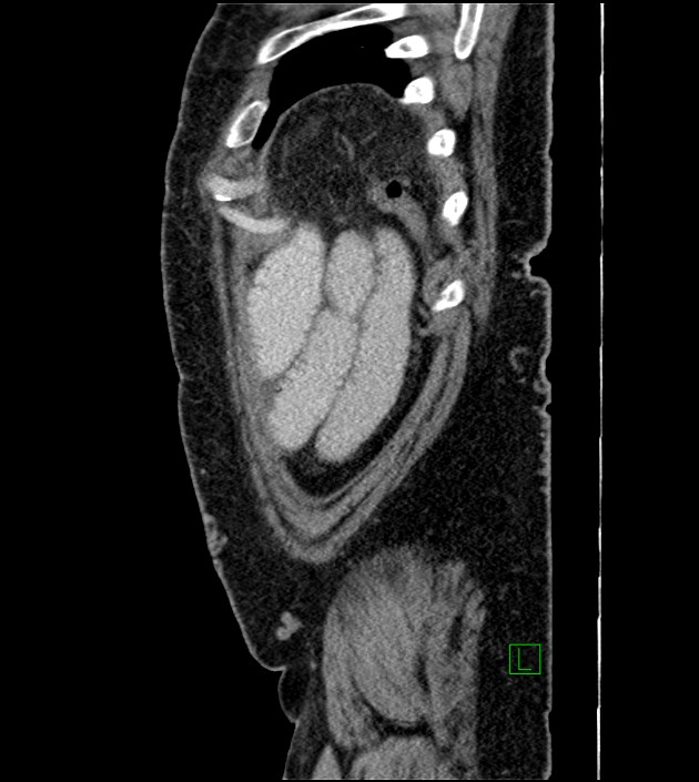 Closed-loop small bowel obstruction-internal hernia (Radiopaedia 78439-91096 C 24).jpg