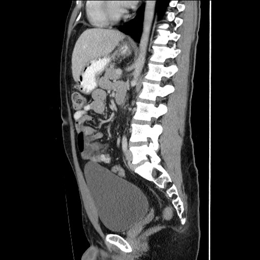 File:Closed-loop small bowel obstruction (Radiopaedia 73713-84509 B 95).jpg