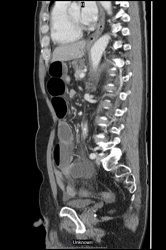 Closed loop bowel obstruction and ischemia (Radiopaedia 86959-103180 C 26).jpg