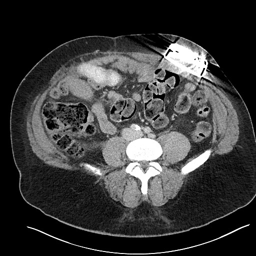 File:Closed loop obstruction - internal hernia into nephrectomy bed (Radiopaedia 59867-67320 A 89).jpg