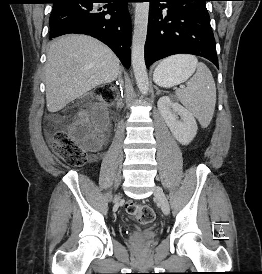 File:Closed loop obstruction - internal hernia into nephrectomy bed (Radiopaedia 59867-67320 B 89).jpg