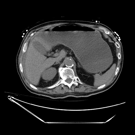 File:Closed loop obstruction due to adhesive band, resulting in small bowel ischemia and resection (Radiopaedia 83835-99023 Axial 119).jpg