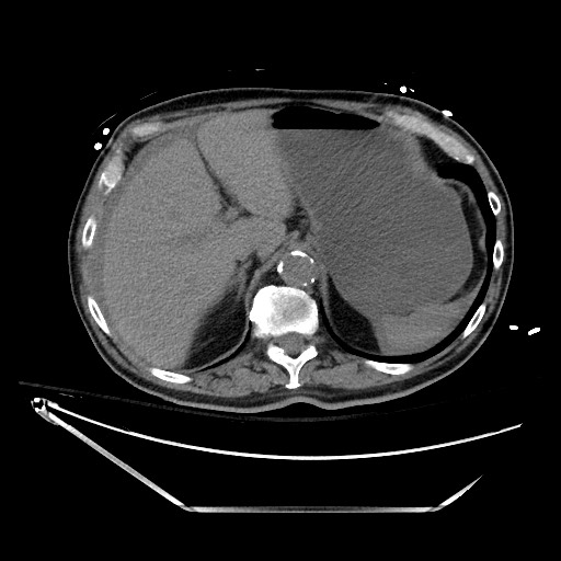 File:Closed loop obstruction due to adhesive band, resulting in small bowel ischemia and resection (Radiopaedia 83835-99023 Axial non-contrast 36).jpg