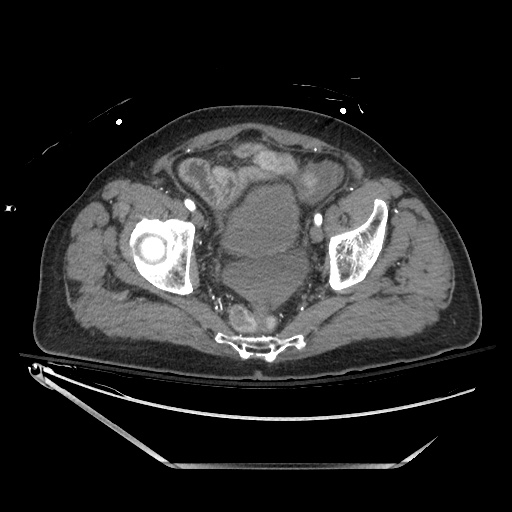 File:Closed loop obstruction due to adhesive band, resulting in small bowel ischemia and resection (Radiopaedia 83835-99023 B 135).jpg