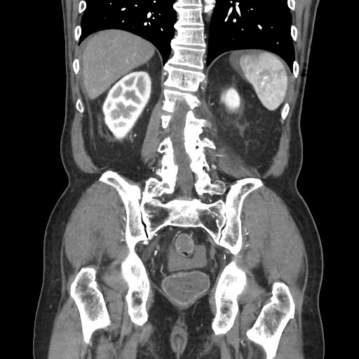 Closed loop obstruction due to adhesive band, resulting in small bowel ischemia and resection (Radiopaedia 83835-99023 C 91).jpg
