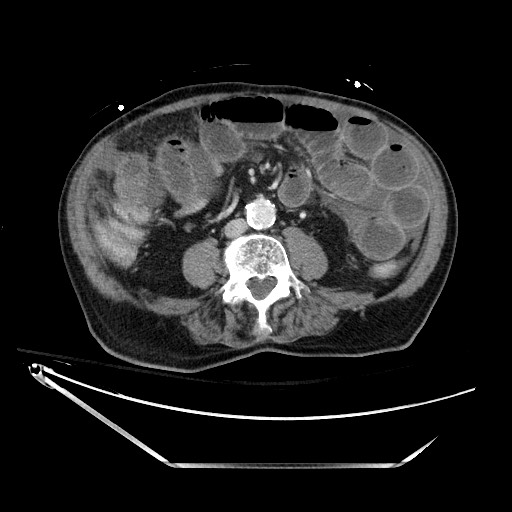 Closed loop obstruction due to adhesive band, resulting in small bowel ischemia and resection (Radiopaedia 83835-99023 D 88).jpg