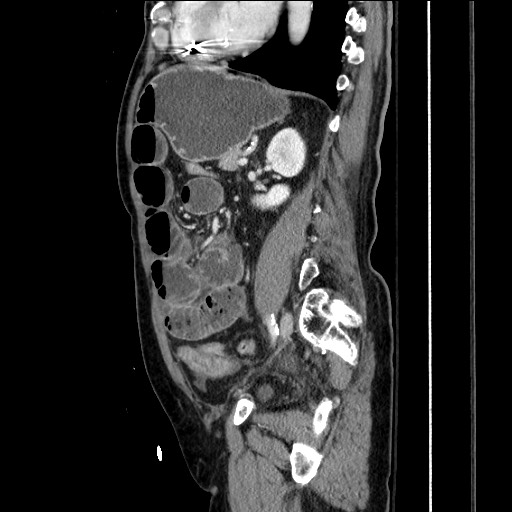 Closed loop obstruction due to adhesive band, resulting in small bowel ischemia and resection (Radiopaedia 83835-99023 F 118).jpg