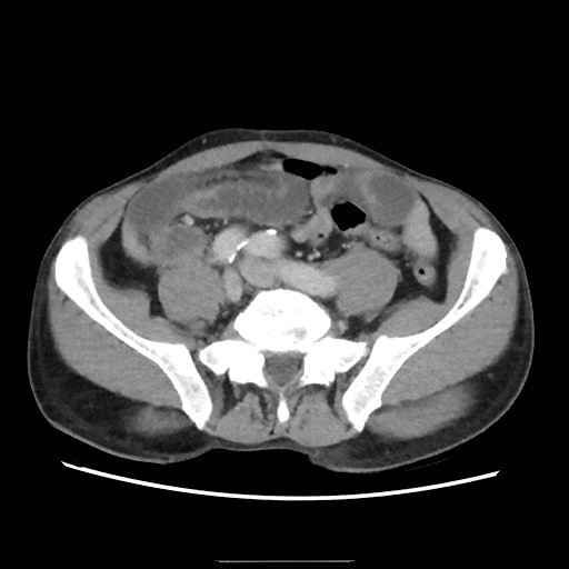 File:Closed loop small bowel obstruction (Radiopaedia 59227-66554 A 60).jpg