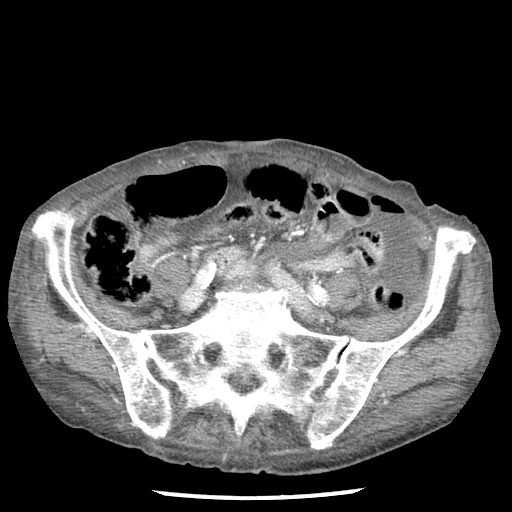 Closed loop small bowel obstruction - adhesions and infarct (Radiopaedia 85125-100678 B 68).jpg