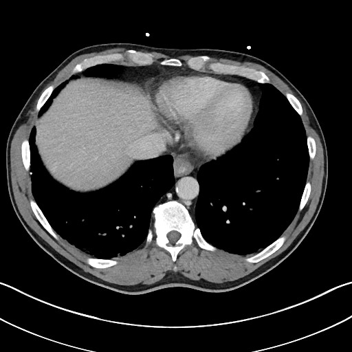 File:Closed loop small bowel obstruction - internal hernia (Radiopaedia 57806-64778 B 12).jpg