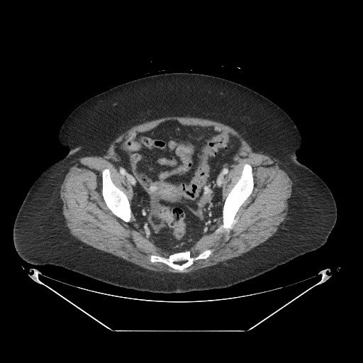 Closed loop small bowel obstruction - internal hernia (Radiopaedia 65402-74450 A 112).jpg