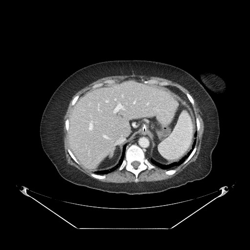 Closed loop small bowel obstruction - internal hernia (Radiopaedia 65402-74450 A 18).jpg
