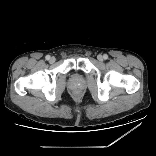 Closed loop small bowel obstruction - omental adhesion causing "internal hernia" (Radiopaedia 85129-100682 A 170).jpg