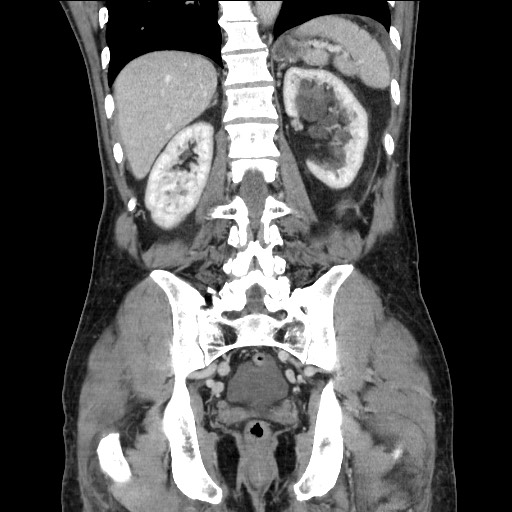 Closed loop small bowel obstruction - omental adhesion causing "internal hernia" (Radiopaedia 85129-100682 B 92).jpg