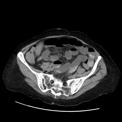 Closed loop small bowel obstruction due to adhesive band, with intramural hemorrhage and ischemia (Radiopaedia 83831-99017 Axial non-contrast 115).jpg
