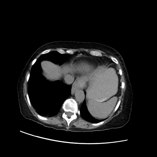 Closed loop small bowel obstruction due to adhesive band, with intramural hemorrhage and ischemia (Radiopaedia 83831-99017 Axial non-contrast 29).jpg