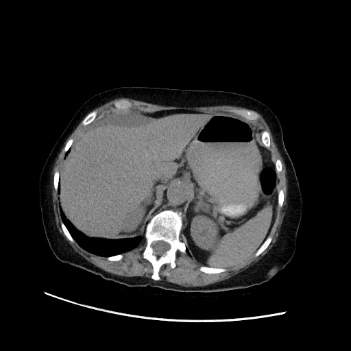 Closed loop small bowel obstruction due to adhesive band, with intramural hemorrhage and ischemia (Radiopaedia 83831-99017 Axial non-contrast 42).jpg
