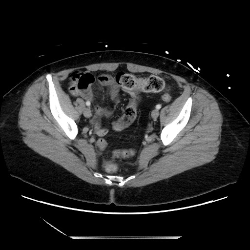 File:Closed loop small bowel obstruction due to adhesive bands - early and late images (Radiopaedia 83830-99014 A 126).jpg