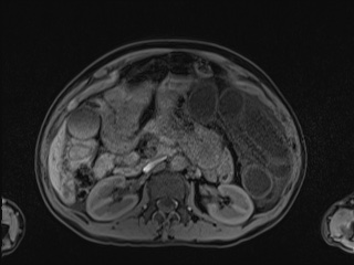 Closed loop small bowel obstruction in pregnancy (MRI) (Radiopaedia 87637-104031 Axial T1 fat sat 49).jpg