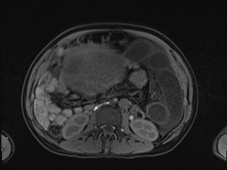 Closed loop small bowel obstruction in pregnancy (MRI) (Radiopaedia 87637-104031 Axial T1 fat sat 60).jpg