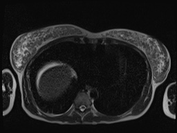File:Closed loop small bowel obstruction in pregnancy (MRI) (Radiopaedia 87637-104031 Axial T2 4).jpg